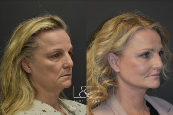 Before & After Facelift & Neck Lift Case 35 Right Oblique View in Palo Alto & San Jose, California