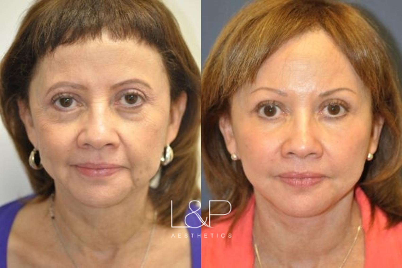 Facelift & Neck Lift Before and After Photos Case 38 Palo Alto & San