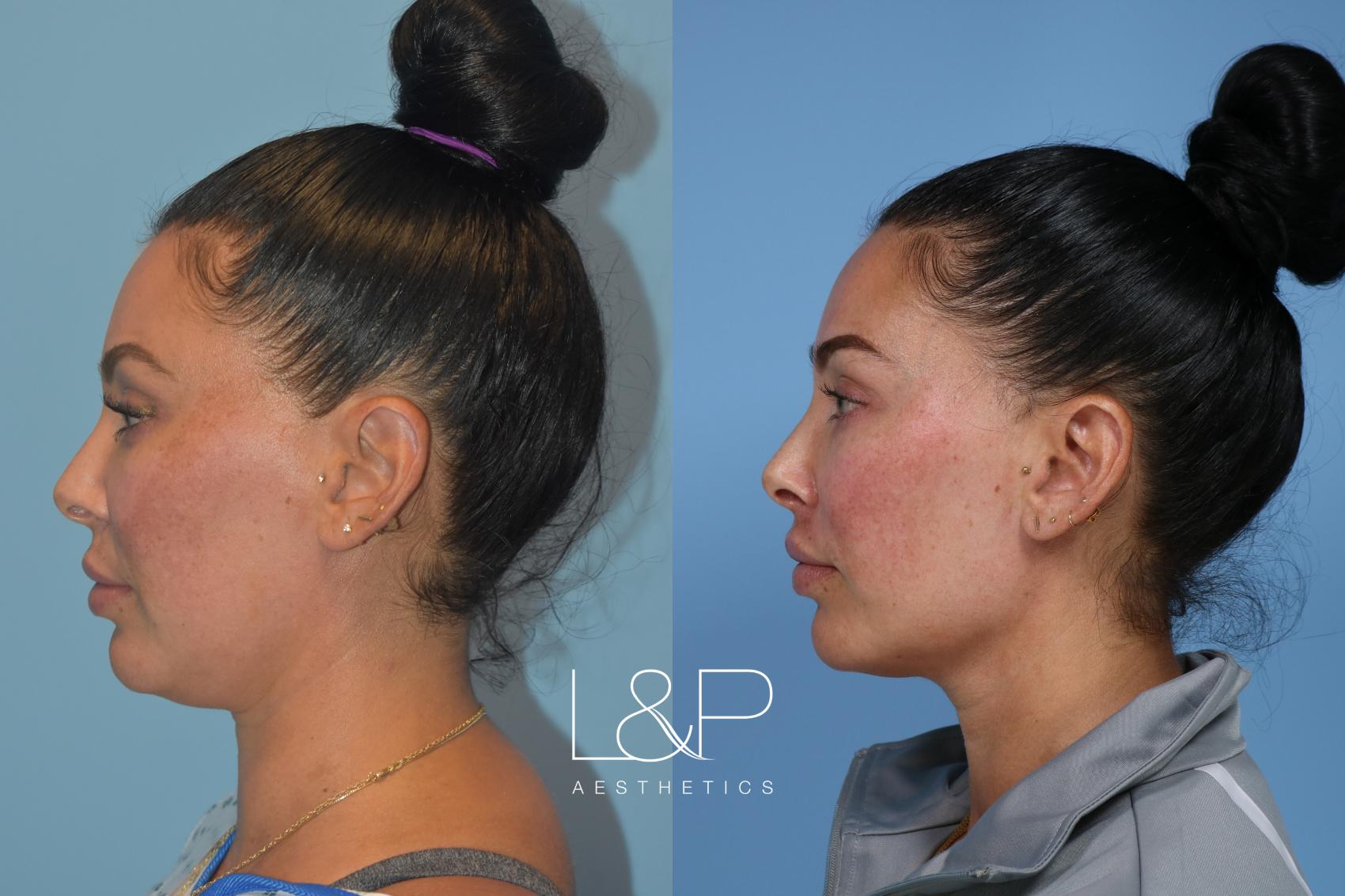 Facetite Accutite Before And After Photo Gallery Palo Alto And San Jose California Landp 7436