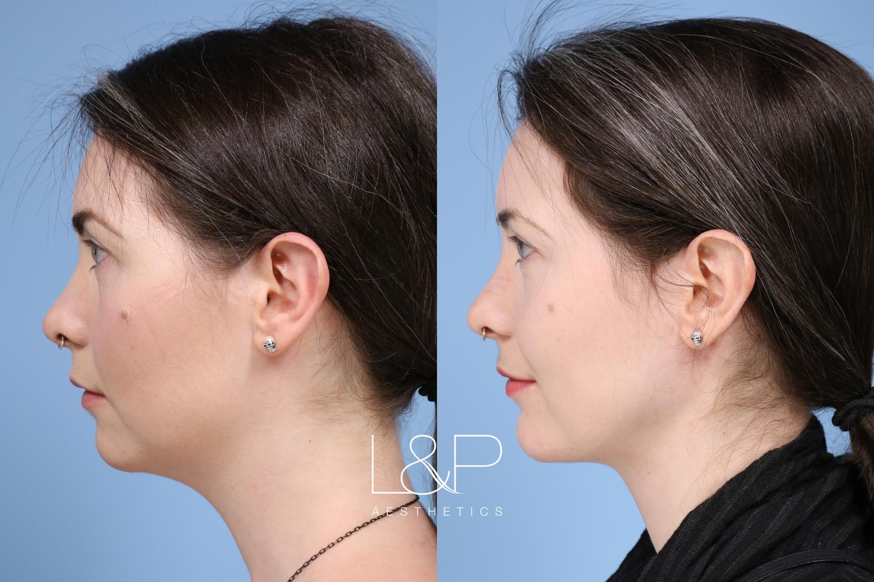 L&P Midline Neck Lift, FaceTite & Chin Implant