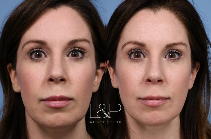Before & After Facial Fillers Case 140 Front View in Palo Alto & San Jose, California