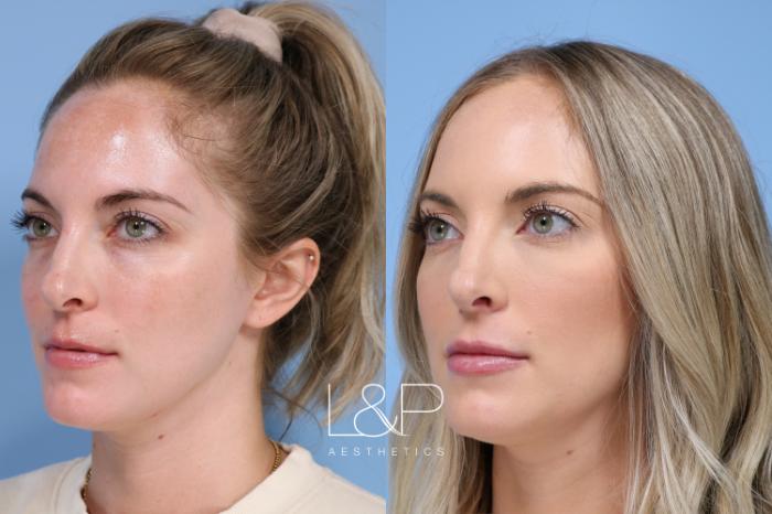 Before & After Facial Fillers Case 155 Left Oblique View in Palo Alto & San Jose, California