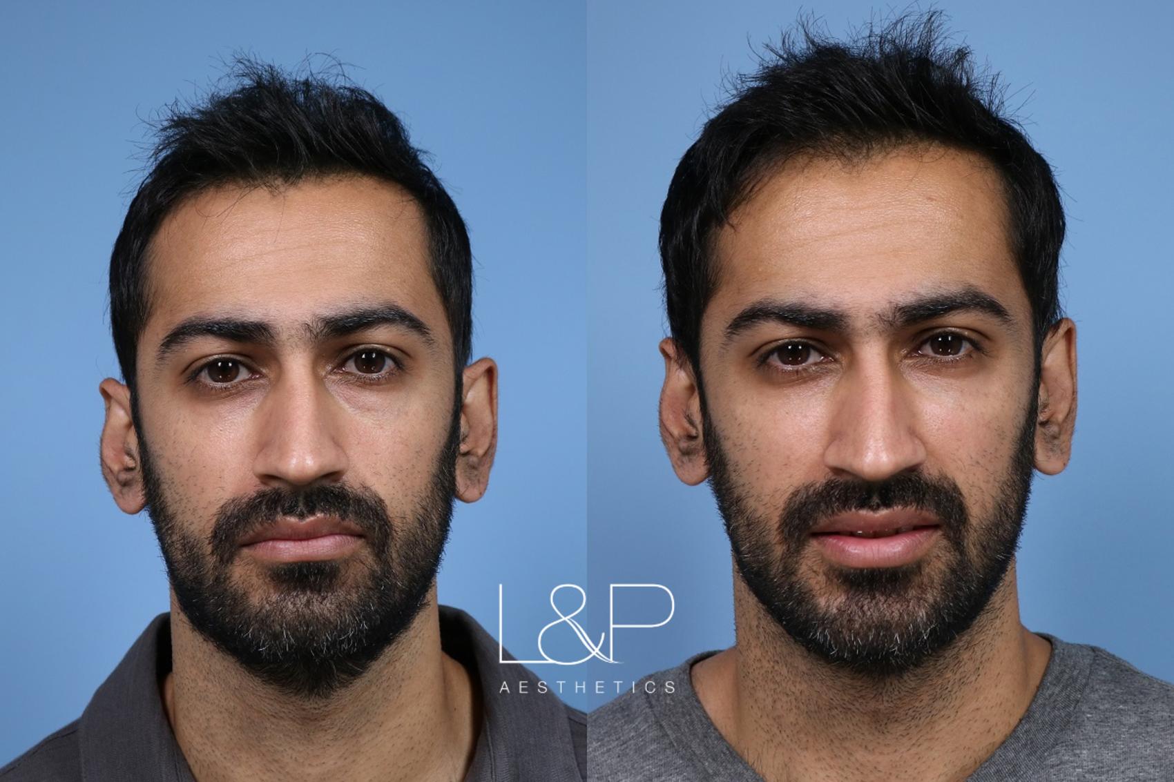 Facial Fillers Before and After Photo Gallery | Palo Alto & San Jose,  California | L&P Aesthetics