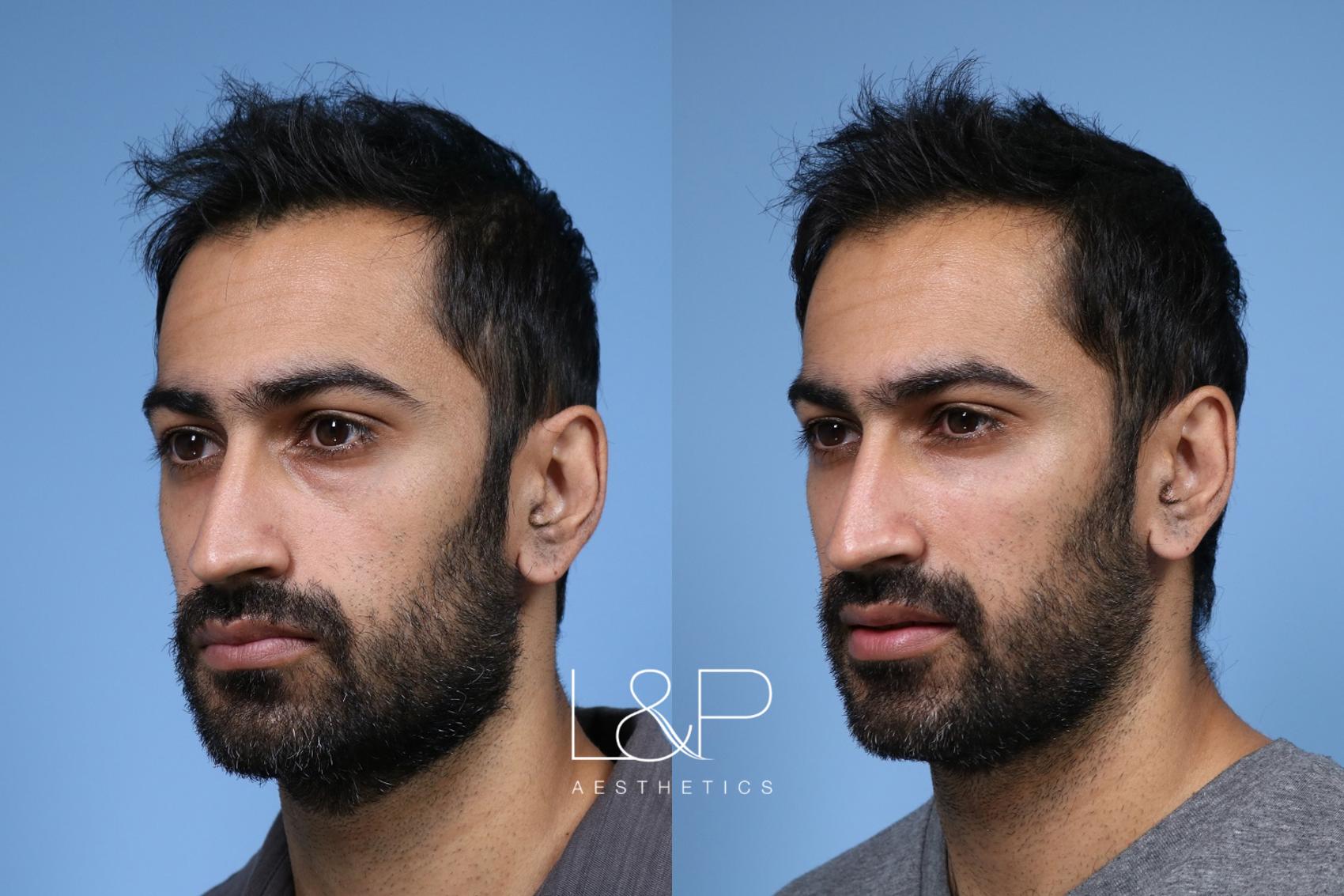 Filler For Under Eyes Before And After At Landp Aesthetics In Palo Alto Ca Bay Area Medspa 7597