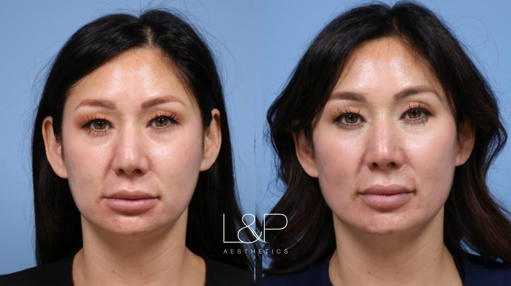 Bay Area Aesthetician refreshes with Facial Filler