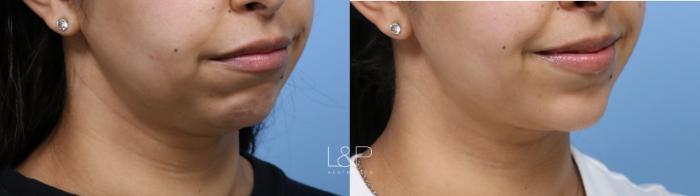Facial Fillers used to define jawline 