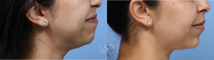 Facial Fillers used to define jawline 