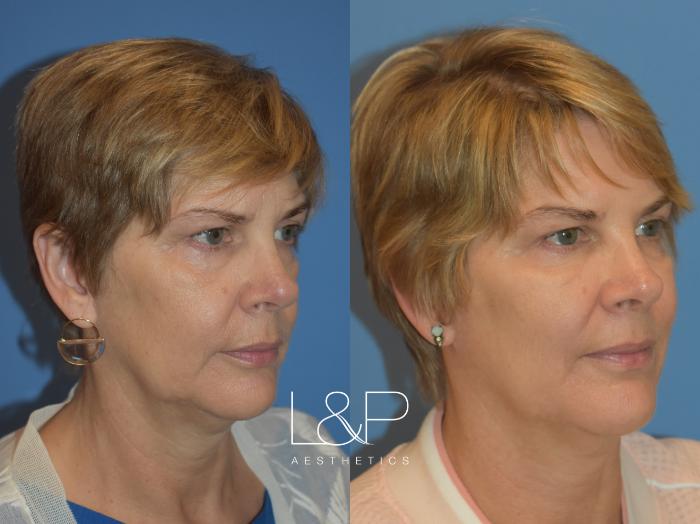 Facial rejuvenation achieved with dermal fillers