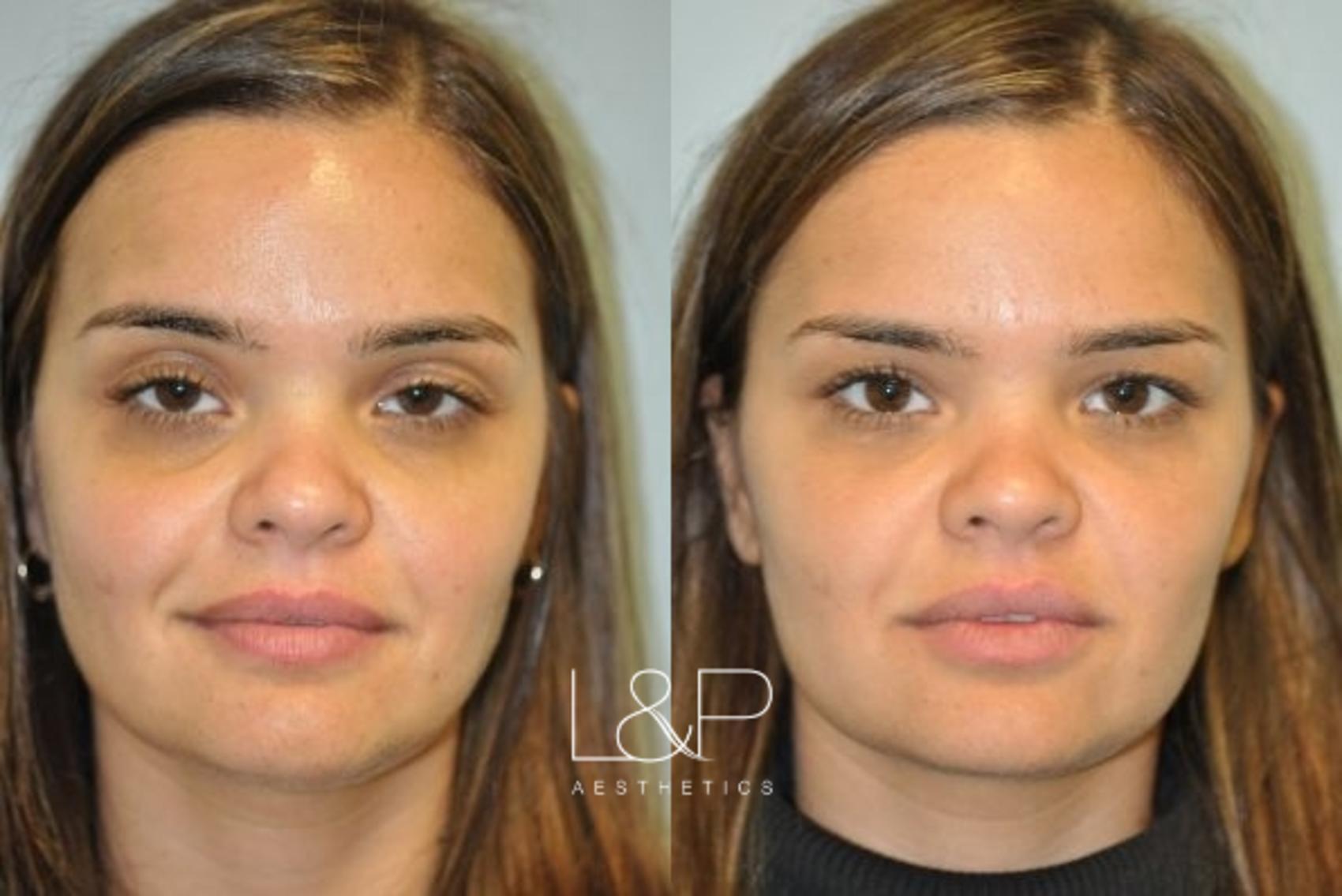 Before & After Facial Fillers Case 78 Front View in Palo Alto & San Jose, California