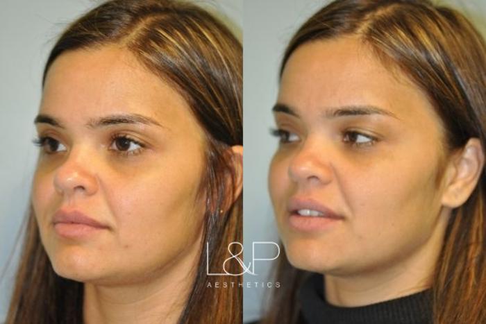 Before & After Facial Fillers Case 78 Left Oblique View in Palo Alto & San Jose, California