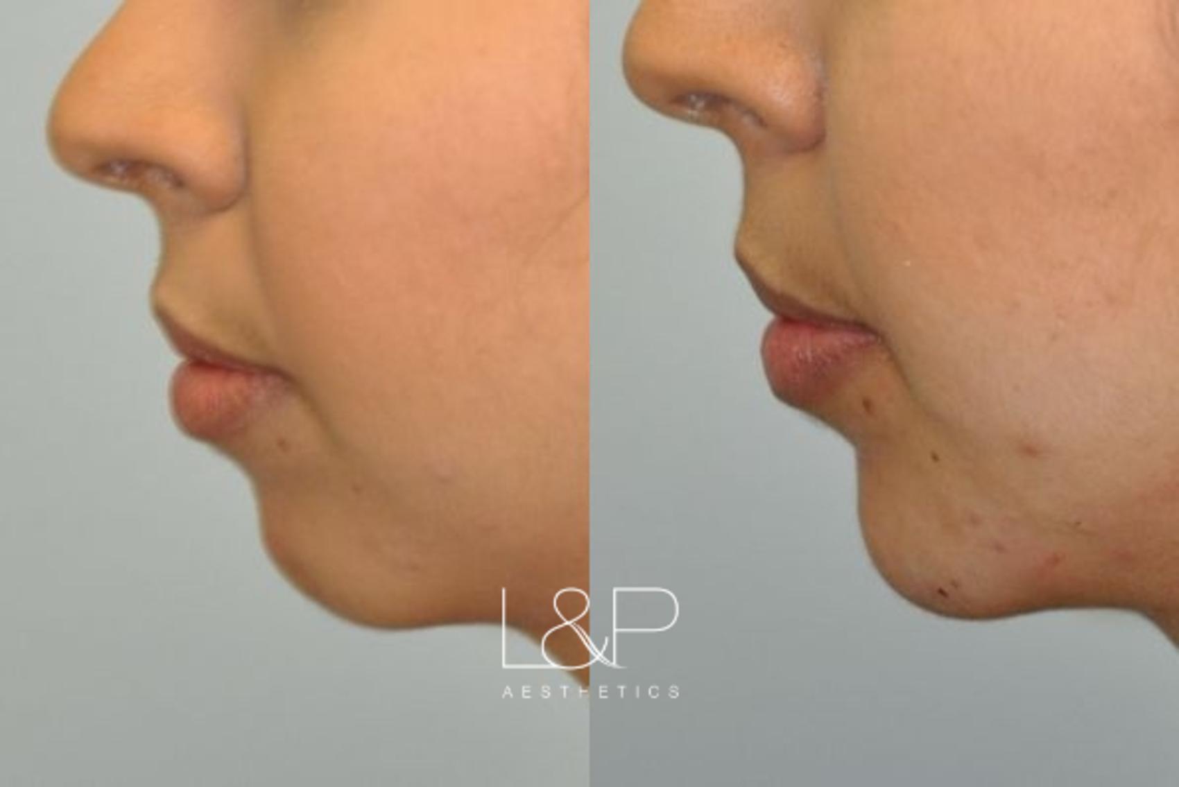 Facial Fillers Before And After Photos Case 84 Palo Alto And San Jose