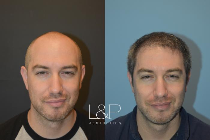 Hair Restoration Before and After 