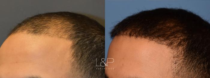 Before and After Hair Restoration 