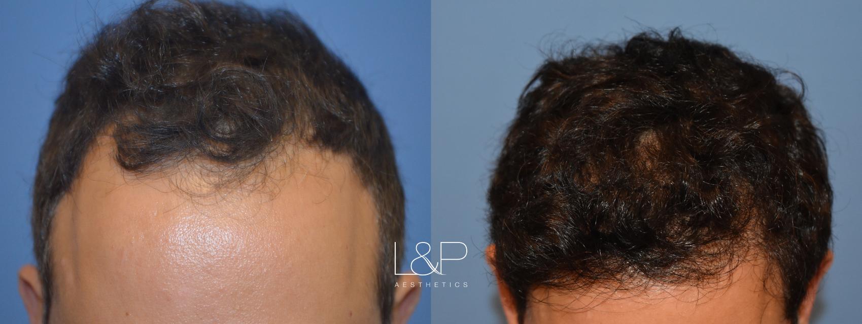 Before and After Hair Restoration