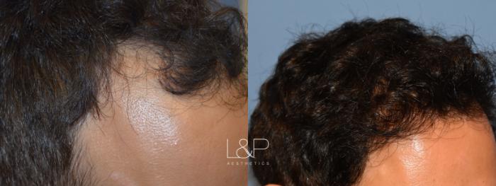 Before and After Hair Restoration