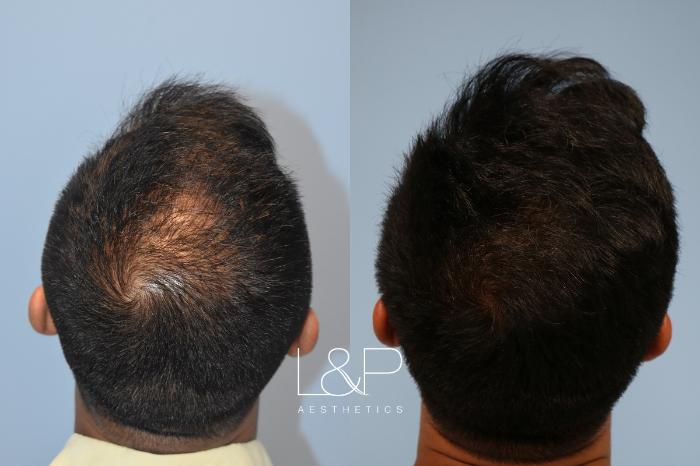 Hair restoration before and after 