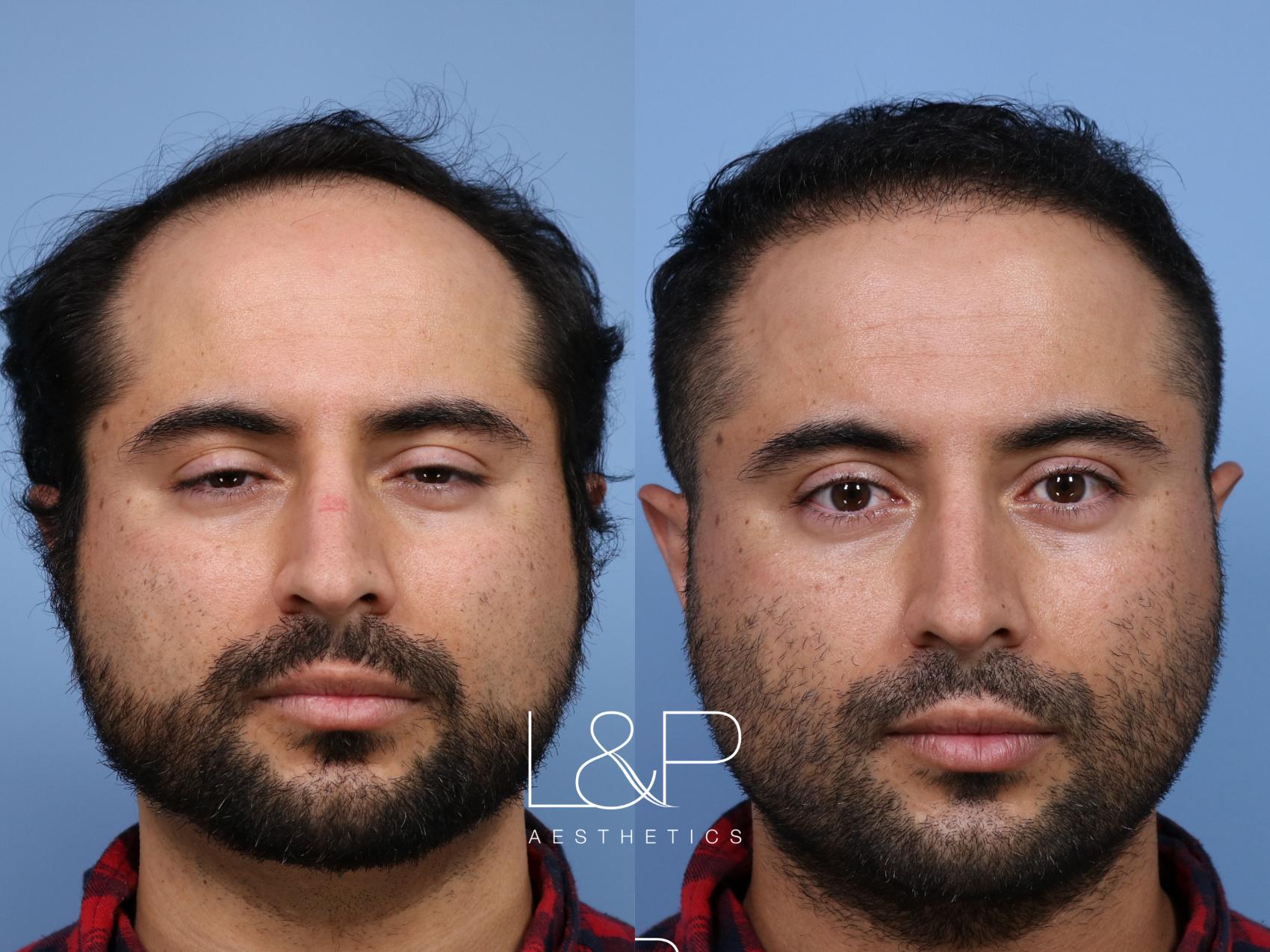 Hair Restoration for Young Bay Area Man