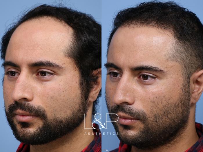 Hair Restoration for Young Bay Area Man