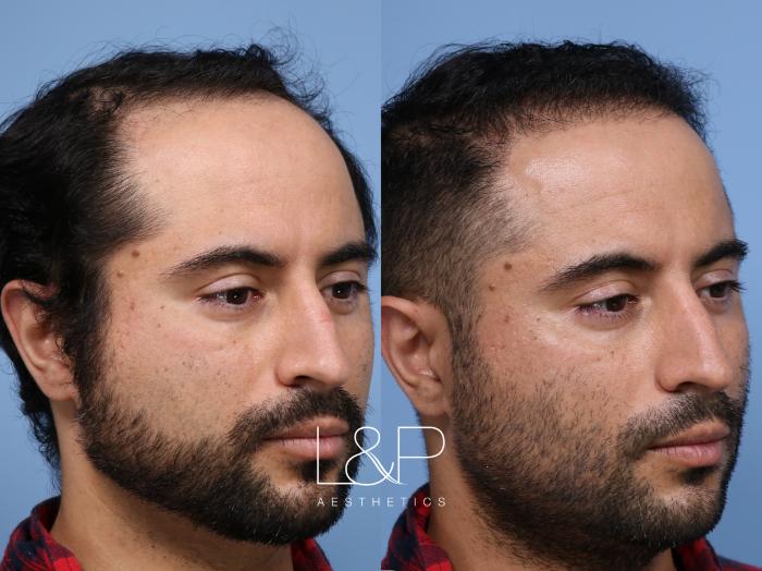 Hair Restoration for Young Bay Area Man