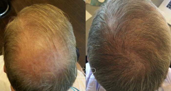 Before & After Hair Restoration Case 62 View 1 View in Palo Alto & San Jose, California
