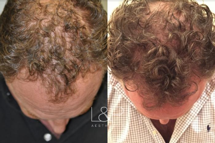 Before & After Hair Restoration Case 63 View 1 View in Palo Alto & San Jose, California