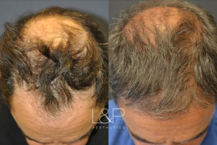 Before & After Hair Restoration Case 64 View 1 View in Palo Alto & San Jose, California
