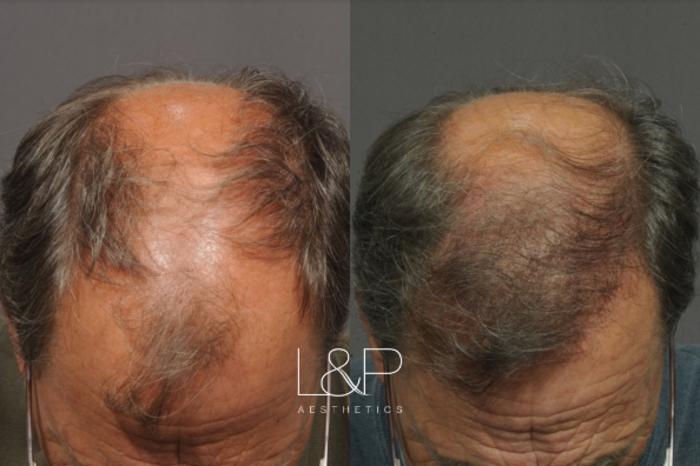 Before & After Hair Restoration Case 65 Front View in Palo Alto & San Jose, California