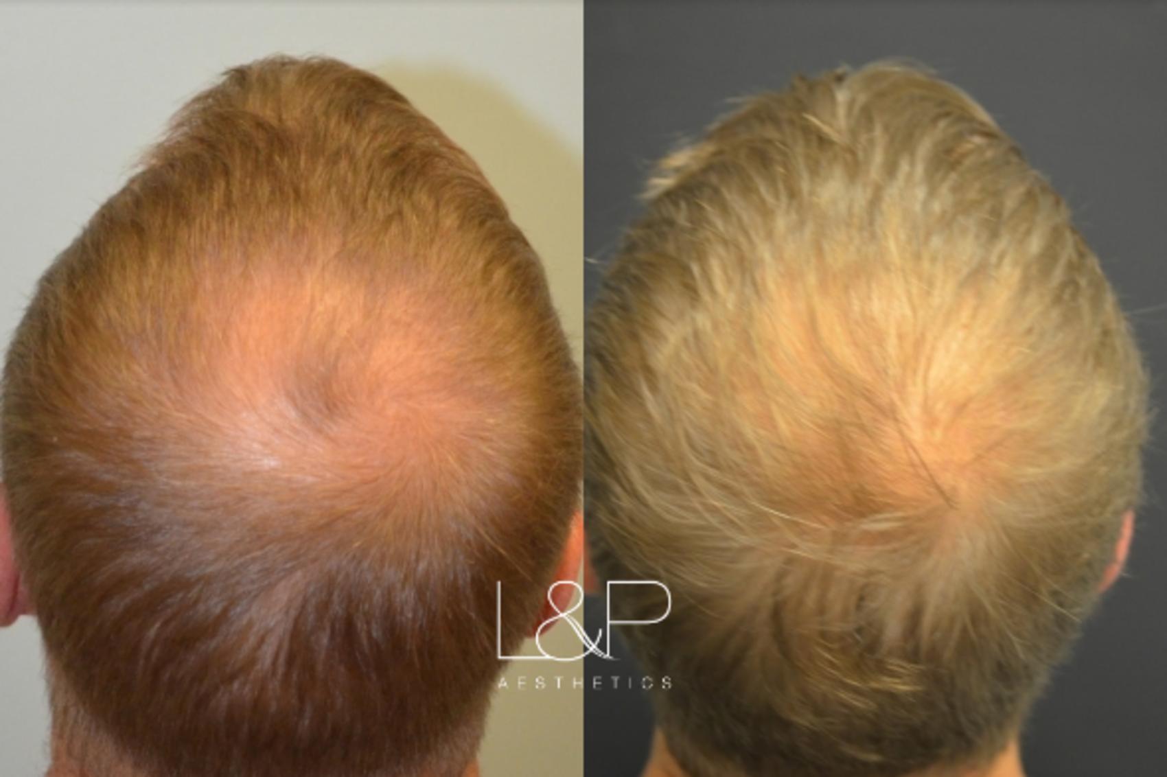 Before & After Hair Restoration Case 66 View 1 View in Palo Alto & San Jose, California