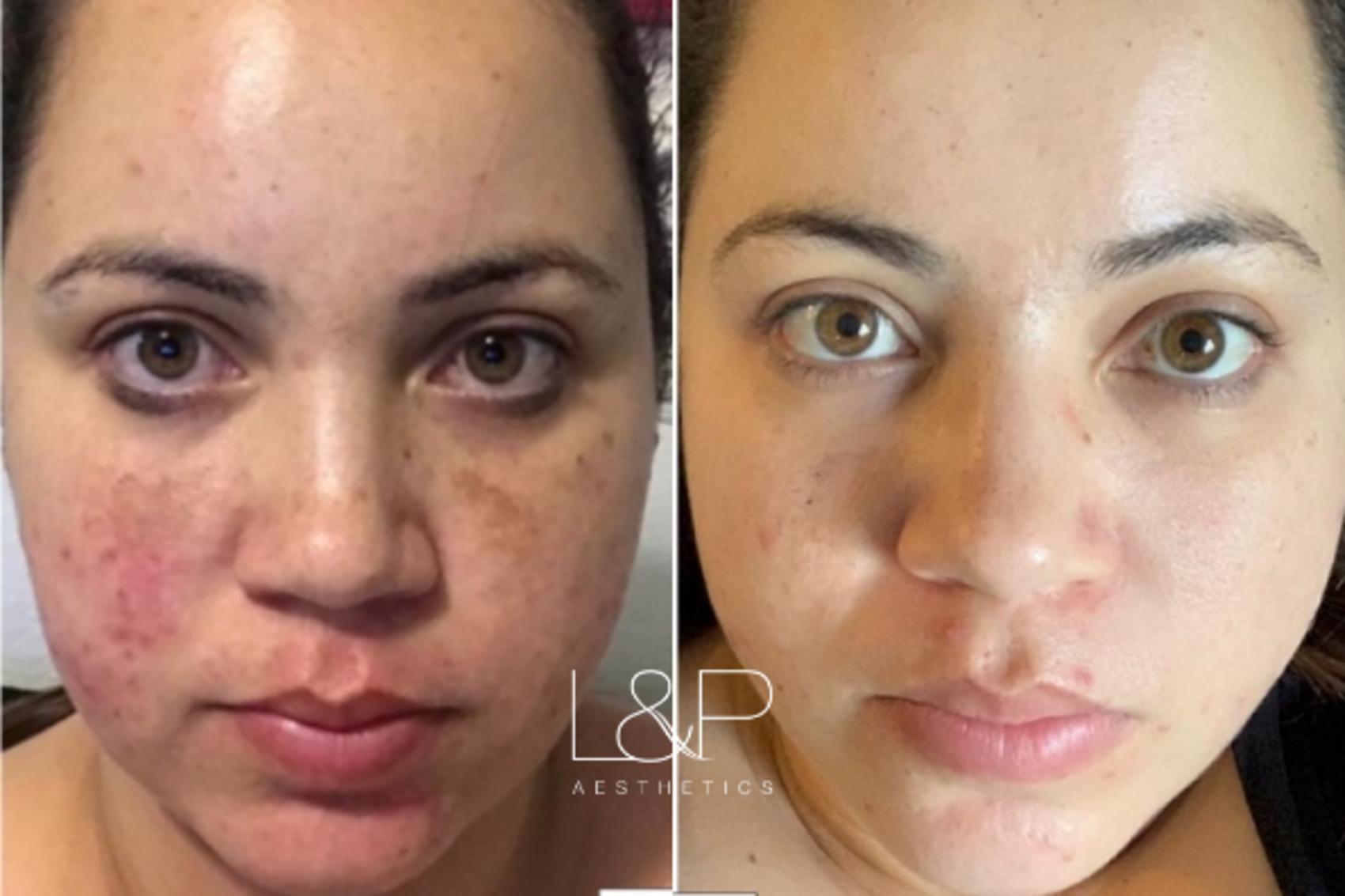 What Does Your Face Look Like After Bbl Treatment Your Magazine Lite