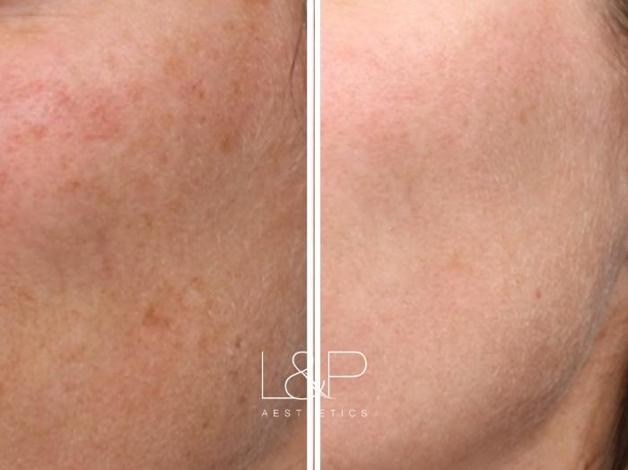 Pigmentation and Skin Discoloration addressed with Halo BBL