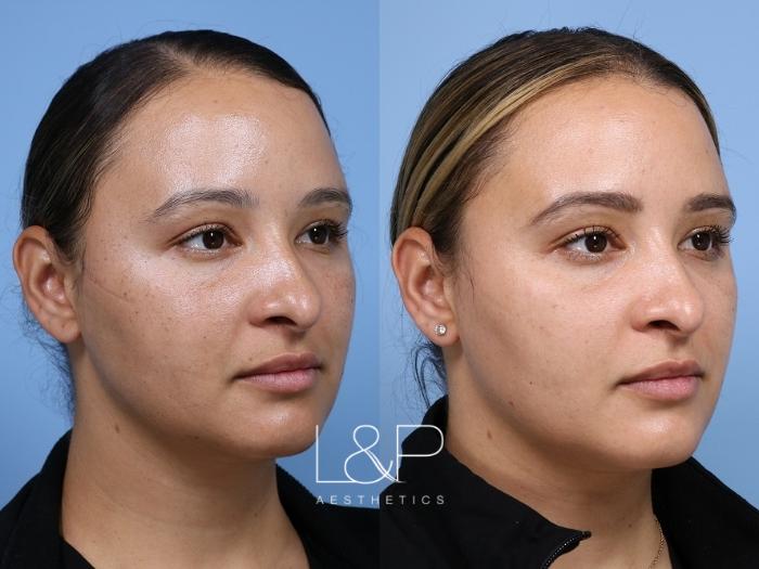 Phenomenal skin transformation from L&P Aesthetics Laser Treatments 