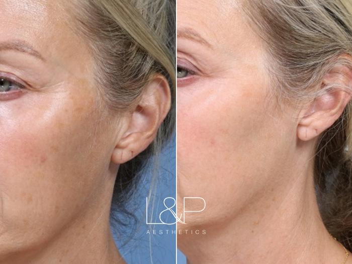 Aging pigmentation concerns addressed with Broad Band Light