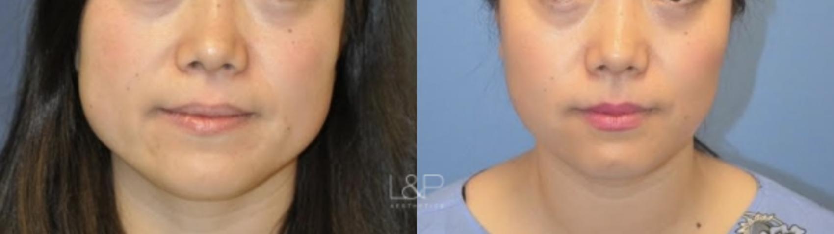 Before & After Jaw Slimming Case 112 Front View in Palo Alto & San Jose, California