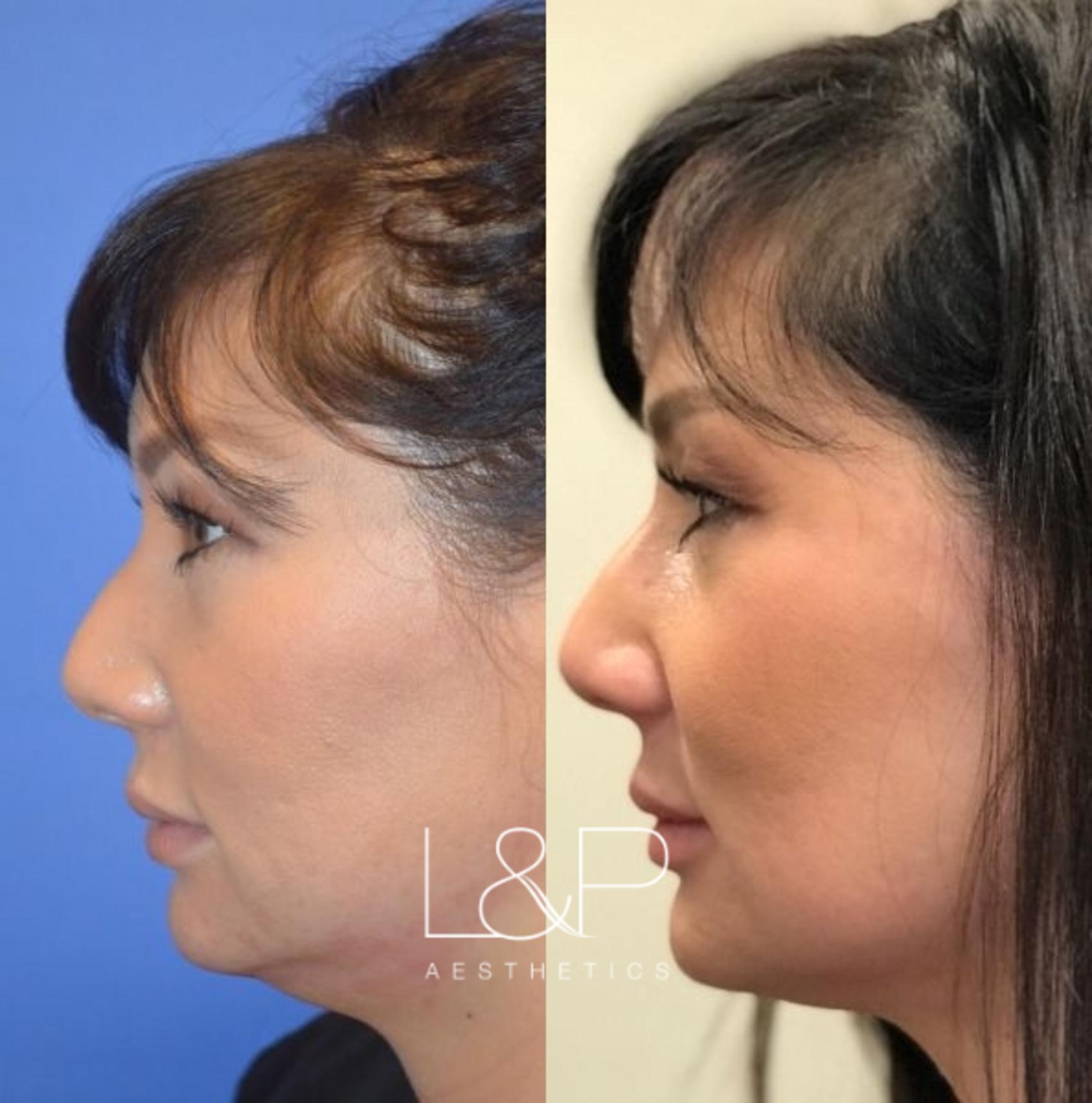 Kybella for a Chiseled Jawline, Utah Facial Plastics