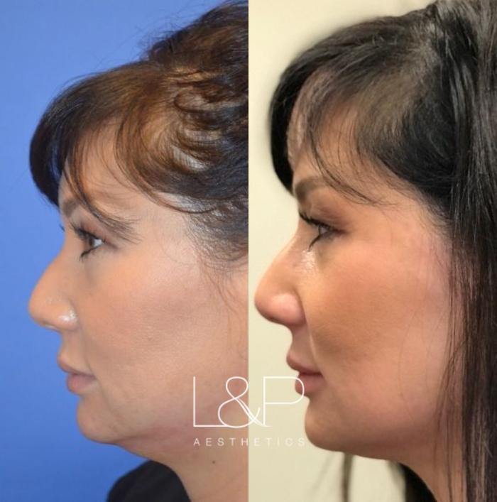Before & After Kybella® Case 103 Left Side View in Palo Alto & San Jose, California