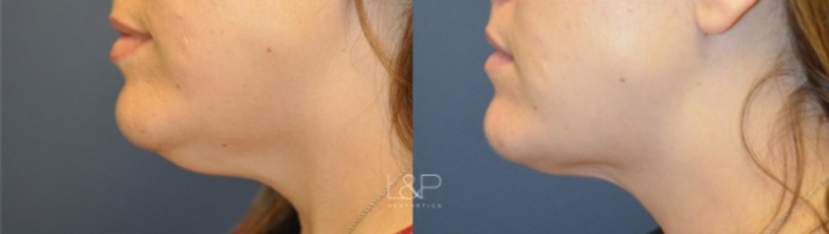 Before & After Kybella® Case 104 Left Side View in Palo Alto & San Jose, California