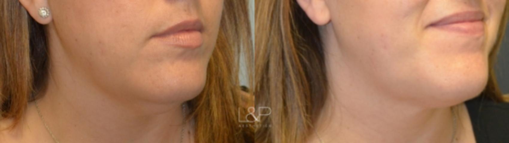 Kybella for a Chiseled Jawline, Utah Facial Plastics