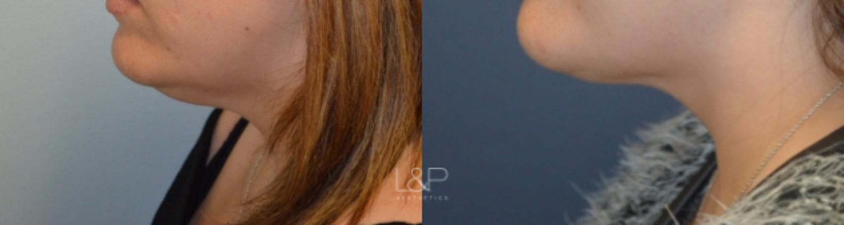 Before & After Kybella® Case 104 View 3 View in Palo Alto & San Jose, California