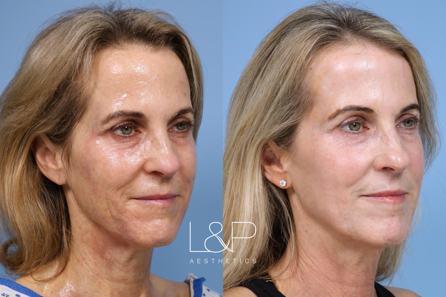 Terrific TRL Laser For Bay Area Woman