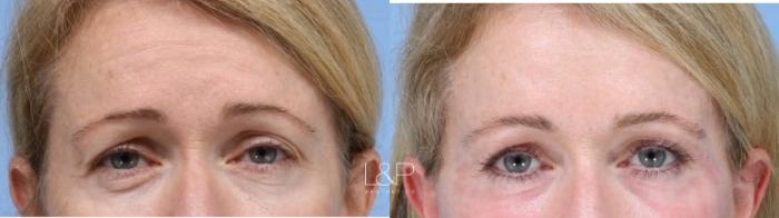Bay Area Woman Rejuvenates her eyes with Laser Resurfacing