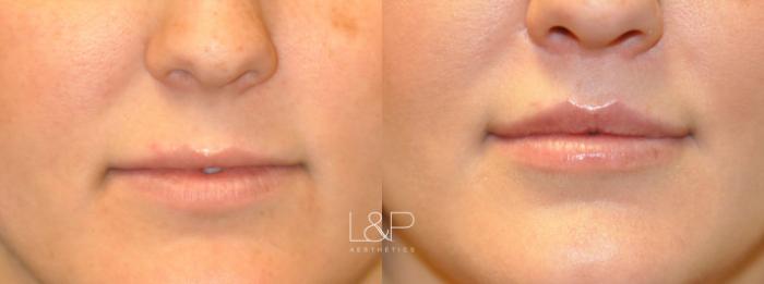 Before and After Lip Augmentation 
