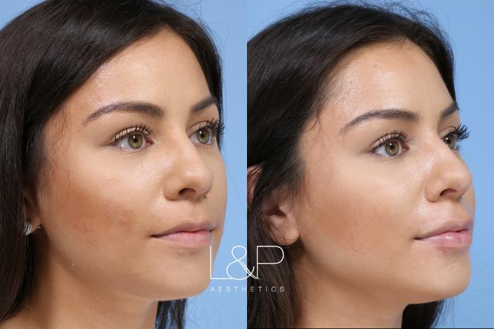 Before & After Lip Augmentation Case 157 Right Oblique View in Palo Alto & San Jose, California