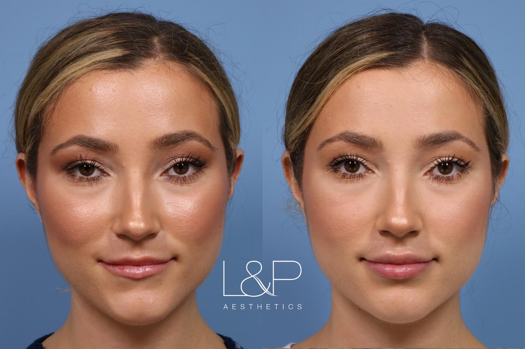 Before & After Lip Augmentation Case 158 Front View in Palo Alto & San Jose, California