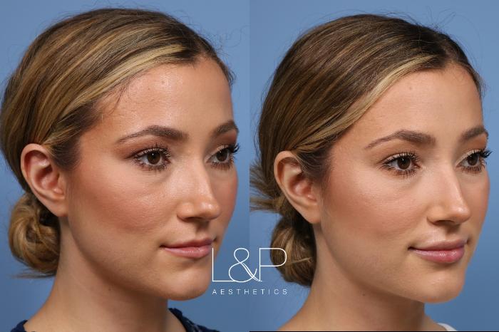 Before & After Lip Augmentation Case 158 Right Oblique View in Palo Alto & San Jose, California