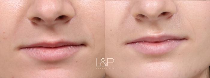 L&P Lip Plump