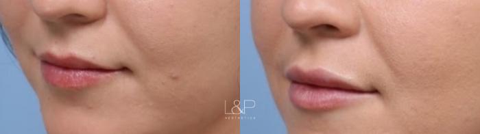 Gorgeous and natural lip augmentation by L&P Aesthetics