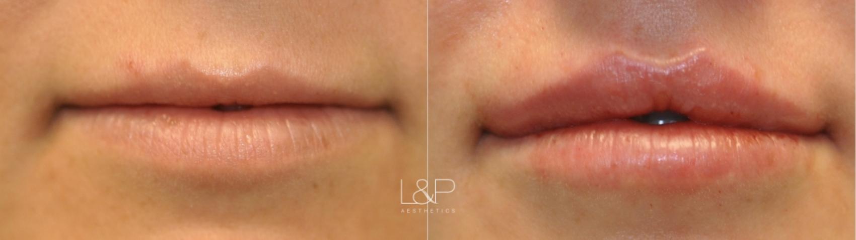 Lip filler for vertical lines of the upper lip… aka “smoker” or “straw  lines”. Used a small amount of Juvederm Volbella in this patient to…