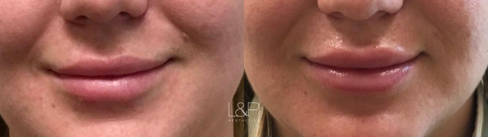 Before & After Lip Augmentation Case 93 Front View in Palo Alto & San Jose, California