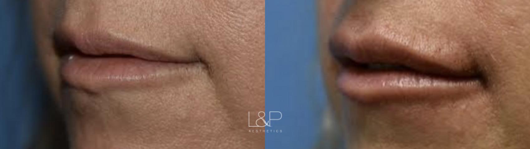 Getting The Lip Augmentation In Beverly Hills, Ca - Dr. Jason Diamond To Work thumbnail