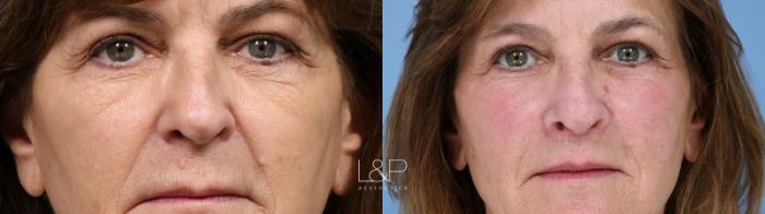 Lip Lift and TRL Laser done to the face